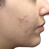 The Ultimate Guide to Clear, Youthful Skin in Canberra — Acne Treatment, Anti-Aging Solutions, and Laser Options at Sycamore Medi Bar